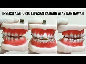 Insersi Alat Ortodonti Lepasan (Typodont)