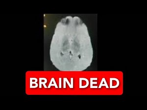 What is Brain Dead ?