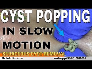 Cyst popping in slow motion
