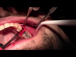 Extraction #13 with Simple Socket Bone Grafting