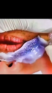 Beeswax hair removal #waxspecialist #BeardRemoval #beard | Wax 101