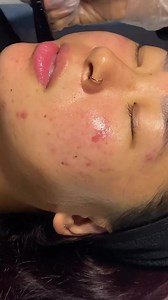 2.6K views · 3 comments | Meet our Acne MediPeel. The powerful blend...