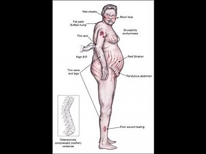 Medical Index - Short and Long Term Side Effects from Corticosteroids
