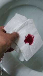 Close-up of blood on toilet paper. Treatment of hemorrhoids in men. Inflammation of the anus due to hemorrhoids and pain in the anus. Bloody discharge from the anus. Health, male, paper, wipe, hemorrh