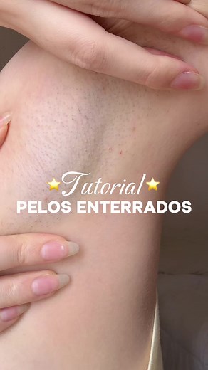 Respuesta a @Mariamsilla Acuña ¿cómo eliminar pelitos enterrador y prevenirlos?😭💘la neta son una lata pero siempre hay soluciones, aquí se me ocurrió rasurarme con rastrillo sin exfoliarme ni nada hace dos semanas y se me enteraron aahhhh #tips #girls #axilasoscuras #depilacion #skincare