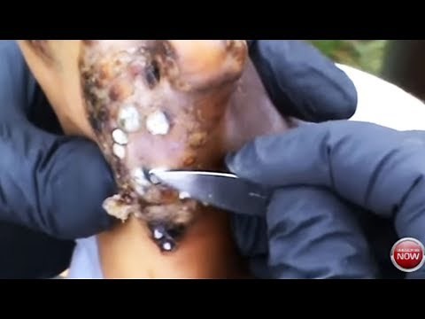 Blackest Jigger Blackhead Removal! Elina of Ebulondi Treatment