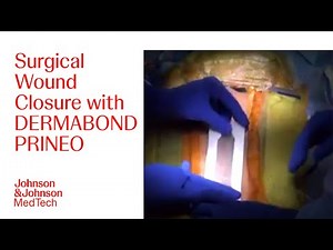 Benefits of Using DERMABOND PRINEO in Post-operative Wound Closure | J&J MedTech
