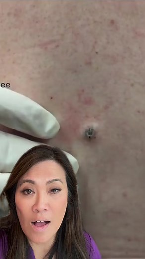 #duet with @Sandra Lee, MD #drpimplepopper a satisfying classic. Not toxic but toxiq #drpimplepopper