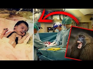 She Was the Recipient of a Baboon Heart Transplant