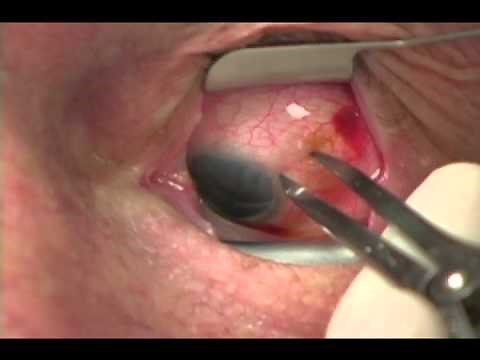 Intraocular Injection of Ranibizumab Therapy for Neovascular Age-Related Macular Degeneration | NEJM