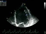 Left Ventriculi Non Compaction • Video • MEDtube.net