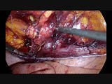 Laparoscopic TAPP for Incarcerated Groin Hernia • Video • MEDtube.net