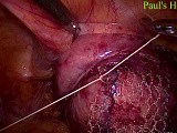 Laparoscopic Pelvic Prolapse Surgery  • Video • MEDtube.net