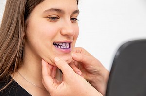 Dentist Demonstrating the Use of Plaque Disclosing Tablets on Teenage...