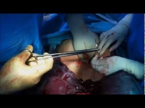 Step by step C-Section (Dr Monir)