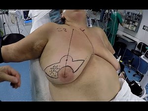 Batwing Oncoplasty & Axillary Lymphadenectomy by Single Port