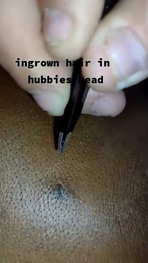 New pimple extraction videos - Loan nguyen new pimple popping videos 2022