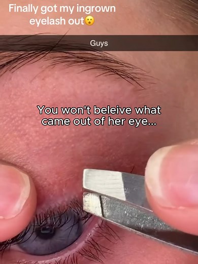 Understanding Trichiasis: The Hidden Dangers of Ingrown Eyelashes