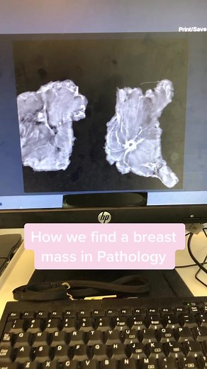 How we find a breast mass in Pathology #beardedPA #pathology #surgicalpathology #faxitron #pathologistsassistant #pathassist #breastmass #breastcancer