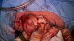 2.2 Meatoplasty method, Alexander Uppheim, Tromso, Norway, 2020