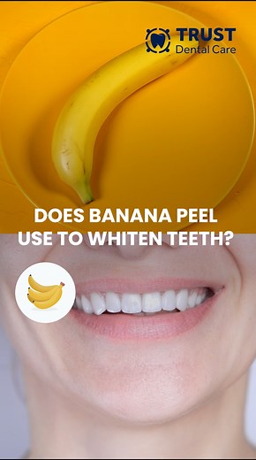 DOES BANANA PEEL USE TO WHITEN TEETH? 🍌🦷 #bananapeel #teethwhitening #mexicodentist #tijuanadentist #reels | Trust Dental Care - Dentist in Tijuana