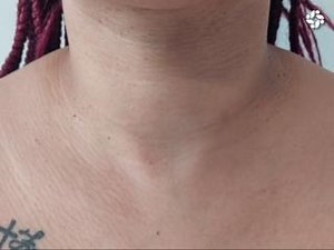 AGEING NECK: A TIMELINE OF TRANSFORMATION In our journey through life, the neck undergoes distinct changes, revealing visible signs of ageing along the way: The 30s: Fine lines and early signs of sagging may start to appear. Skin elasticity begins to decline due to natural collagen loss. The 40s: Deepening wrinkles and creases become more pronounced. Skin laxity intensifies, and the jawline may show signs of drooping. The 50s: Horizontal necklines, known as neckbands, become more noticeable. Ski