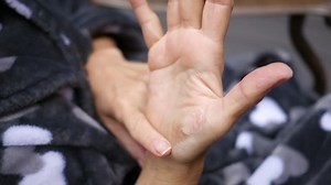 Woman Looks Second Degree Burn Healing: стоковое видео (без лицензионных платежей), 31381852 | Shutterstock