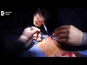 Why is mesh, a foreign body used for Hernia Repair? - Dr. Viswanath S