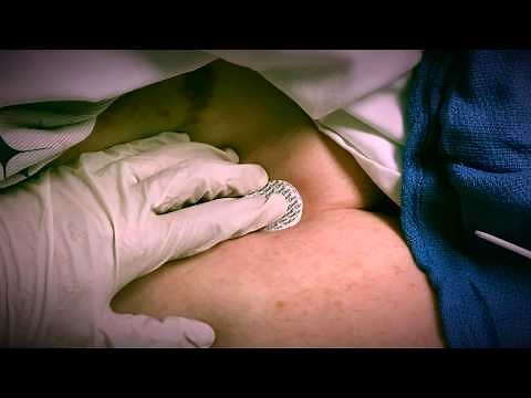 StatSeal Advanced Plus Disc femoral artery sheath removal