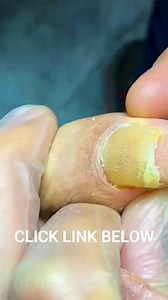 From nasty to fancy- Transforming toenails infected with fungus #Reels | Atlas Professional Risk Management