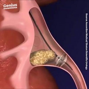 39K views · 427 reactions | How to Remove stone from kidney by new Technology | Medical video | Facebook
