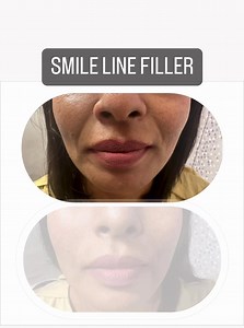 Smile lines, sometimes called laugh lines, are types of wrinkles that primarily develop around the sides of your mouth. Smile lines are more noticeable when you smile. As you age, these types of wrinkles may be inevitable but Injectable fillers are among the top choices to smoothen smile lines !! #smilelines #wrinkles #nasolabialfolds #fillers #drcherry | Dr. Sarah Fazy / Dr. Cherry