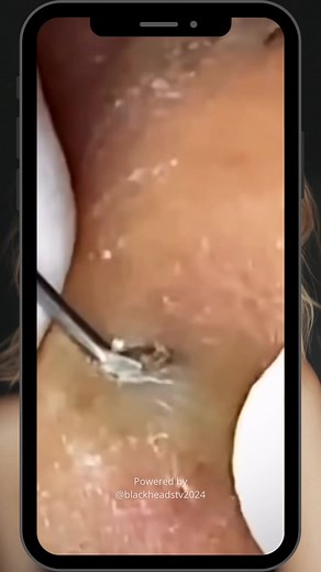 Squeeze Popping Acne Pimple Satisfying Abcess Blackheads Removal Pimple Removal | Viral #blackheadsremoval #cleanskin #acnetreatment #pimplepopping #foryoupage