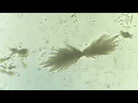 Sulfonamide crystalluria