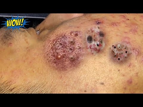 Relax Everyday with Blackheads & Acne Treatment 109