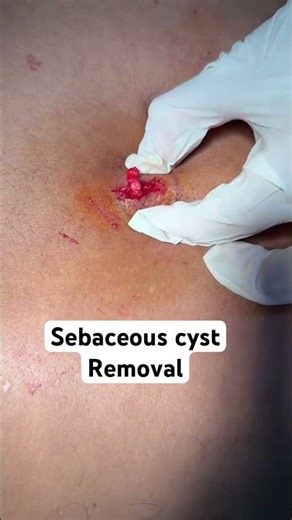 Sebaceous cyst excision #dermatologist #skindoctor