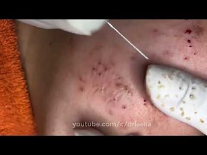 How To Remove Blackheads And Whiteheads On Face Easy #116 ✦ Dr Laelia ✦