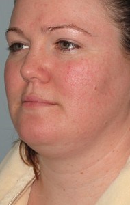 St. Louis Chin, Neck, and Jaw Liposuction | St. Louis Lipo Center