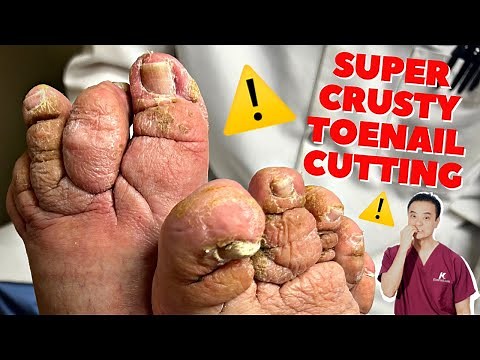 Super Crusty Toenail Cutting and Dry, Dead Skin Removal!! | *SATISFYING NAIL CUT* | Dr. Kim