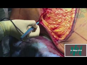 Lower bodylift combined with gluteal implants