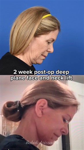 1.2K views | My patient is 2 weeks post-op from deep plane face and...