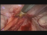 Laproscopic Removal of Prolene Mesh • Video • MEDtube.net