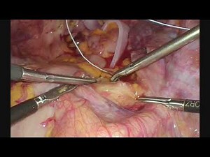 Laparoscopic Ventral Mesh Rectopexy with Biologic Mesh | Case Review | ASCRS 2019 Best Video