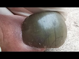 The Stinkiest Toenails Ever! Watch This Shocking Transformation