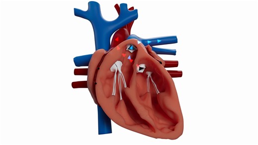 Your heart has four valves that control the blood into the four chambers of your heart. Valvular heart disease is when these valves get tight or leaky, leading to health issues. Dr. Elvis Peter, interventional cardiologist at Marshfield Clinic, talks about open heart surgery and TAVR, two options your cardiology team can use to treat valvular heart disease. | Marshfield Clinic Health System