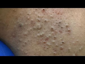 Say Goodbye to Acne: Deep Cleansing Techniques for Clear Skin