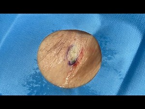 Armpit Cyst and Sac Removal | CONTOUR DERMATOLOGY