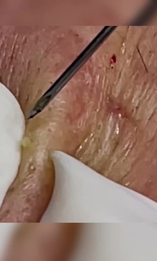 #spa #acneskin #acnefighter