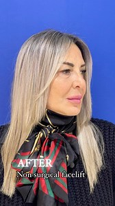 Non Surgical Facelift ( droopy & saggy Face) ✨PRGF PLASMA GEL ✨MICROTHREADS ✨LIFTING UP FILLER ✨BOTOX ✨CHIN LIPOLYSIS Dr.Hala 📍Abu Dhabi Book now 📞0097126666988 #clinicajoelle #beauty #clinica #dermatology #nonsurgical #facelift #healthyskin #antiage #youngerlook #filler #botox #viral #viralreels #viralvideo #explore #exploremore #uae #abūdhabī | Clinica Joelle