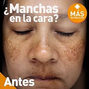 1.3K views | Derma Peru on Reels | Facebook